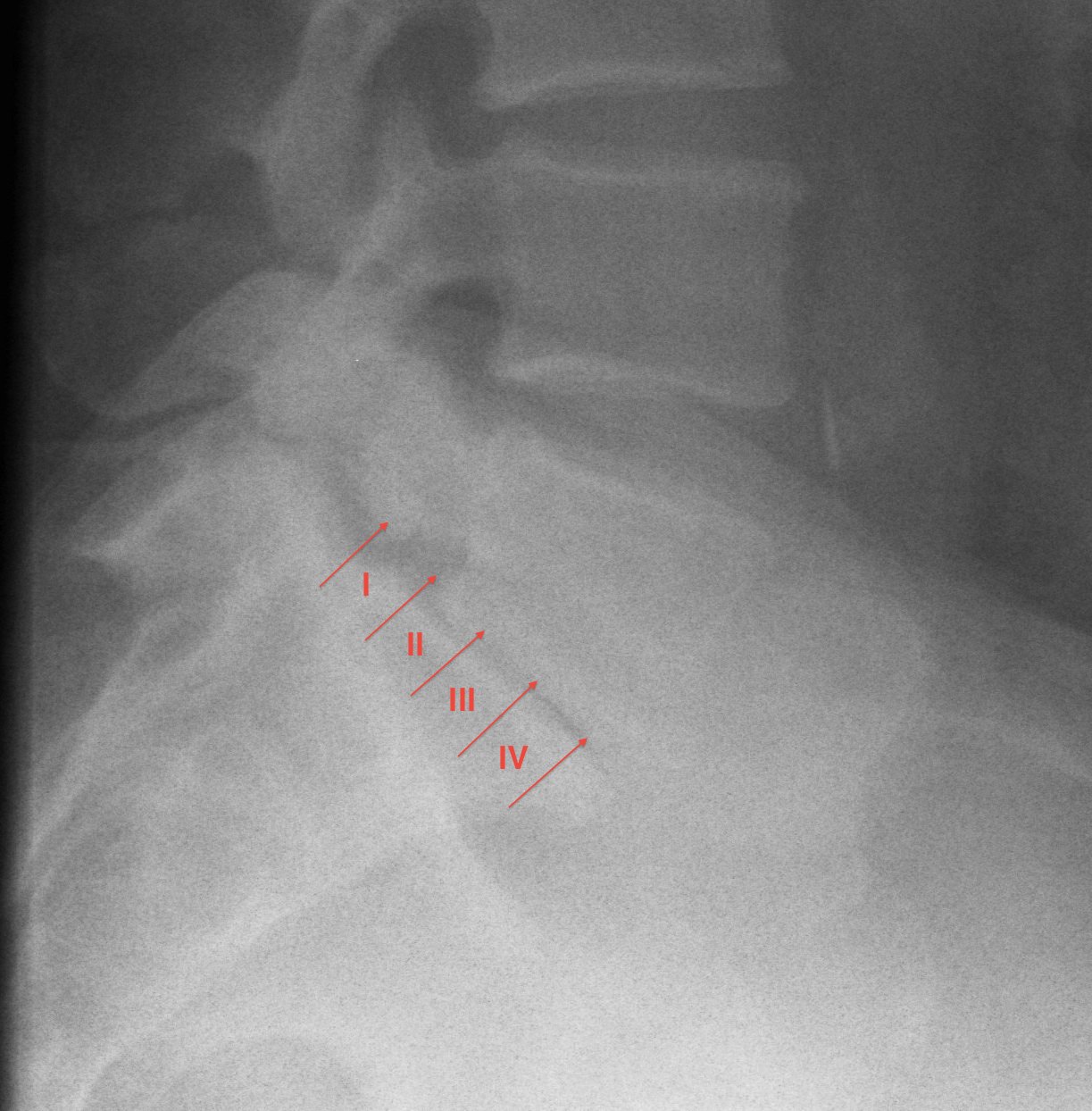 Spondylolithesis Meyerding Classification